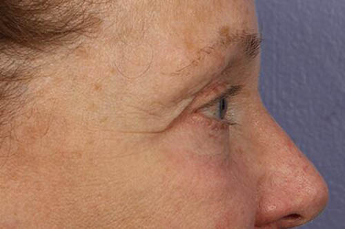 Eyelid Surgery Before & After Image