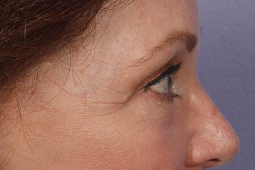 Eyelid Surgery Before & After Image