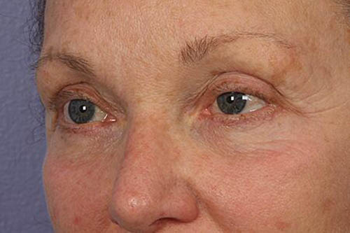 Eyelid Surgery Before & After Image