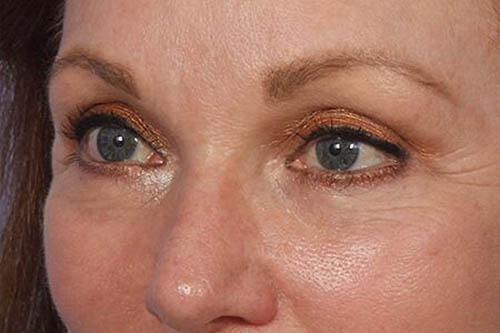 Eyelid Surgery Before & After Image