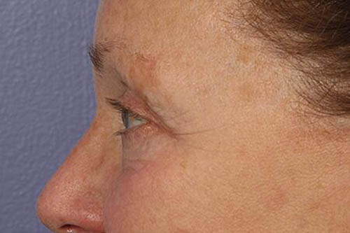 Eyelid Surgery Before & After Image