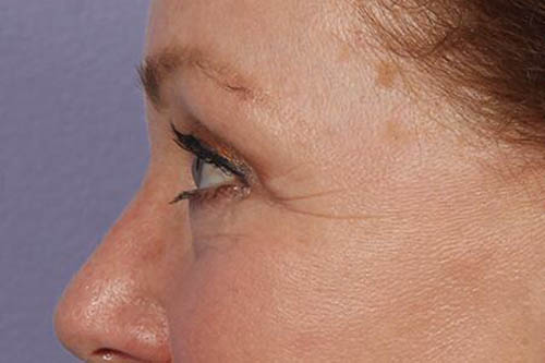 Eyelid Surgery Before & After Image