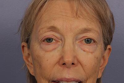 Eyelid Surgery Before & After Image