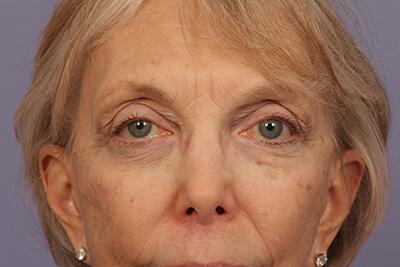 Eyelid Surgery Before & After Image