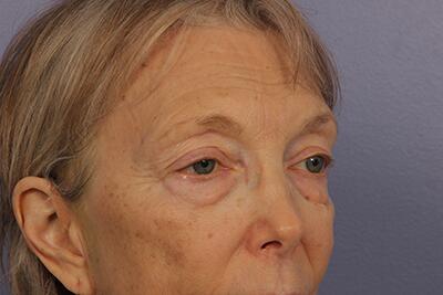 Eyelid Surgery Before & After Image