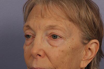 Eyelid Surgery Before & After Image