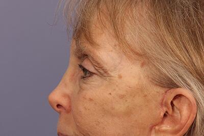 Eyelid Surgery Before & After Image