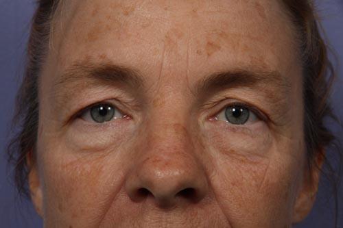 Eyelid Surgery Before & After Image