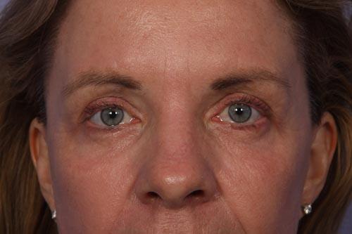 Eyelid Surgery Before & After Image