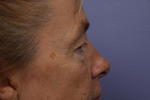 Eyelid Surgery Before & After Image