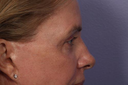 Eyelid Surgery Before & After Image