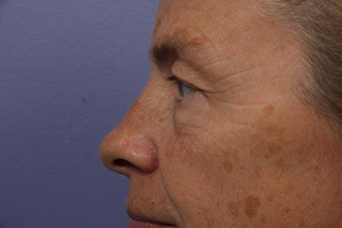 Eyelid Surgery Before & After Image