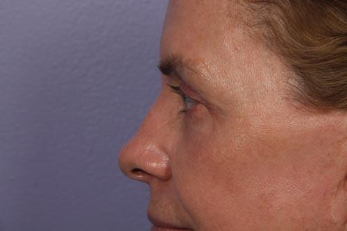 Eyelid Surgery Before & After Image