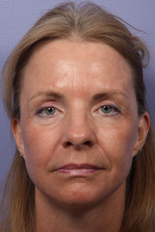 Eyelid Surgery Before & After Image