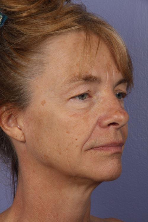 Eyelid Surgery Before & After Image