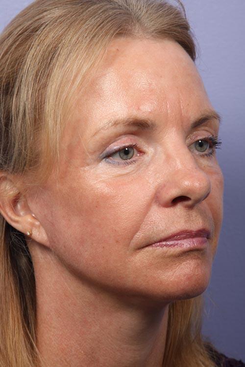 Eyelid Surgery Before & After Image