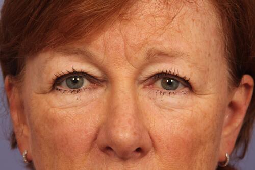 Eyelid Surgery Before & After Image