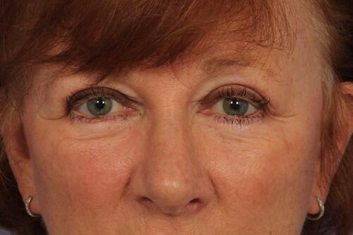 Eyelid Surgery Before & After Image