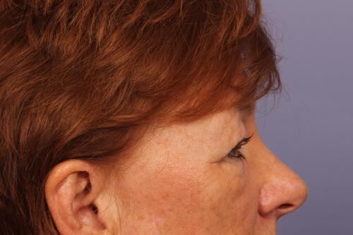 Eyelid Surgery Before & After Image