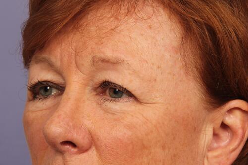 Eyelid Surgery Before & After Image