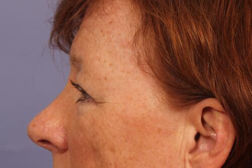 Eyelid Surgery Before & After Image