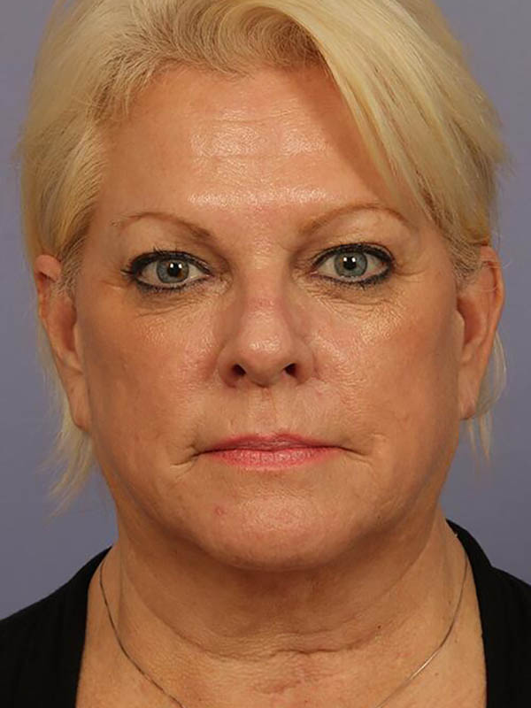 Eyelid Surgery Before & After Image