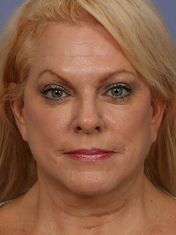 Eyelid Surgery Before & After Image