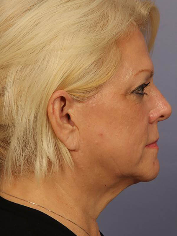 Eyelid Surgery Before & After Image