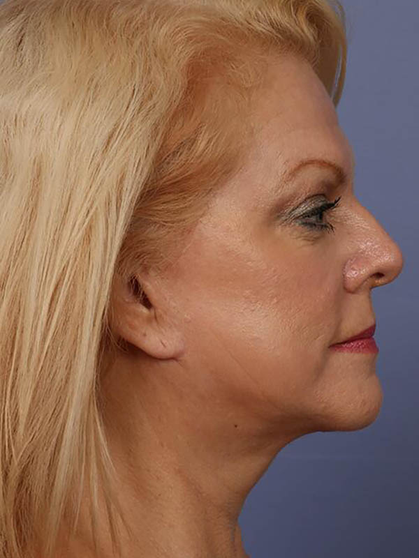 Eyelid Surgery Before & After Image