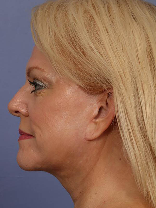 Eyelid Surgery Before & After Image