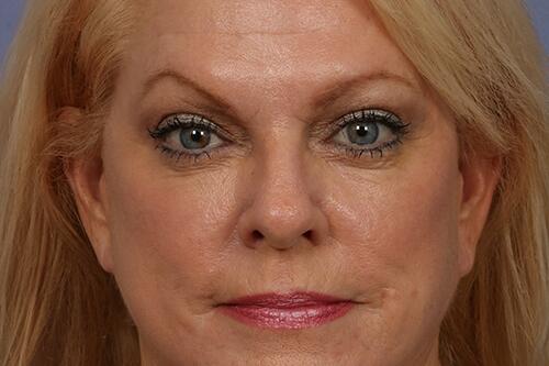 Eyelid Surgery Before & After Image