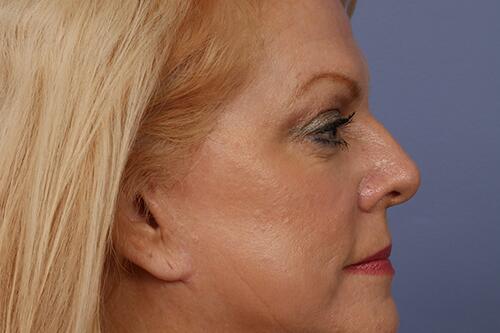 Eyelid Surgery Before & After Image