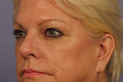 Eyelid Surgery Before & After Image