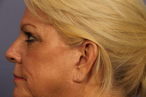 Eyelid Surgery Before & After Image