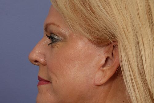 Eyelid Surgery Before & After Image