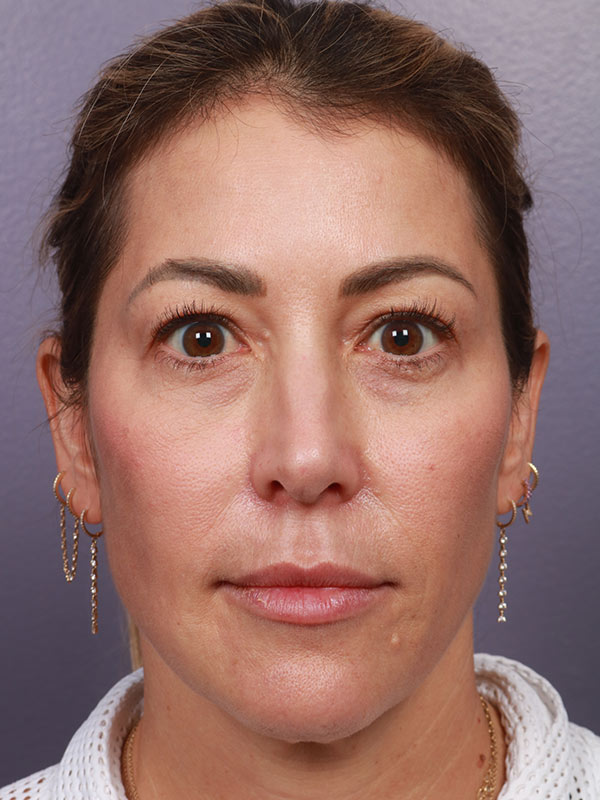 Eyelid Surgery Before & After Image