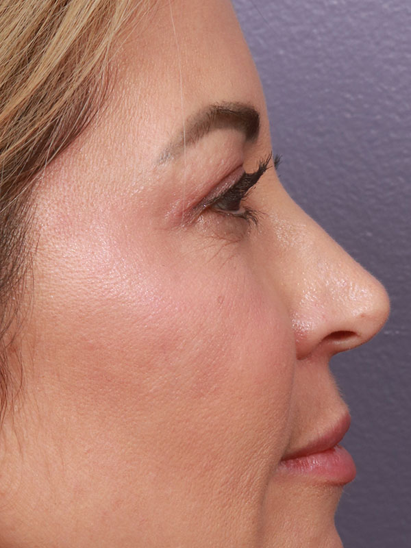 Eyelid Surgery Before & After Image