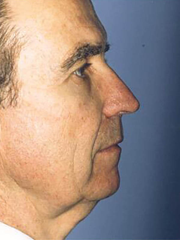 Eyelid Surgery Before & After Image