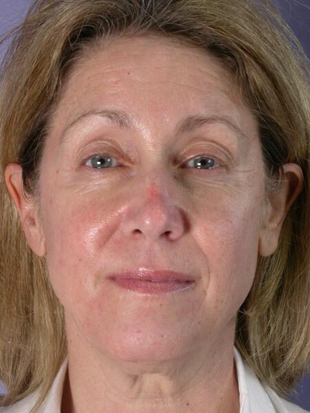 Eyelid Surgery Before & After Image