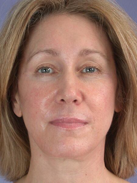 Eyelid Surgery Before & After Image