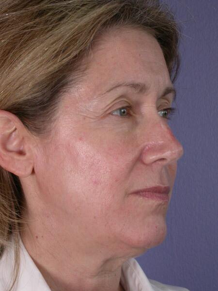 Eyelid Surgery Before & After Image