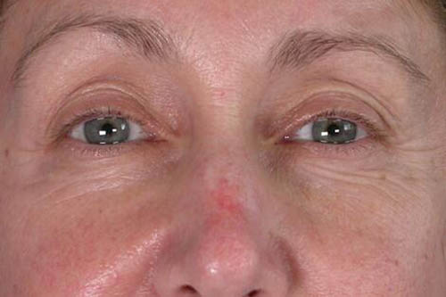 Eyelid Surgery Before & After Image