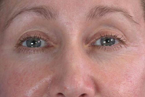 Eyelid Surgery Before & After Image