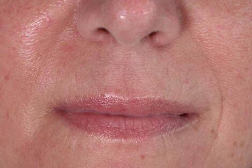 Eyelid Surgery Before & After Image