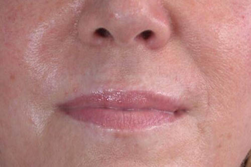 Eyelid Surgery Before & After Image