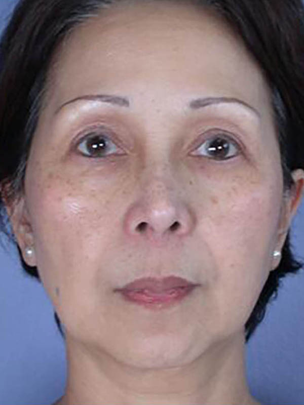 Facelift Before & After Image