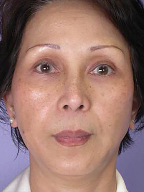 Facelift Before & After Image