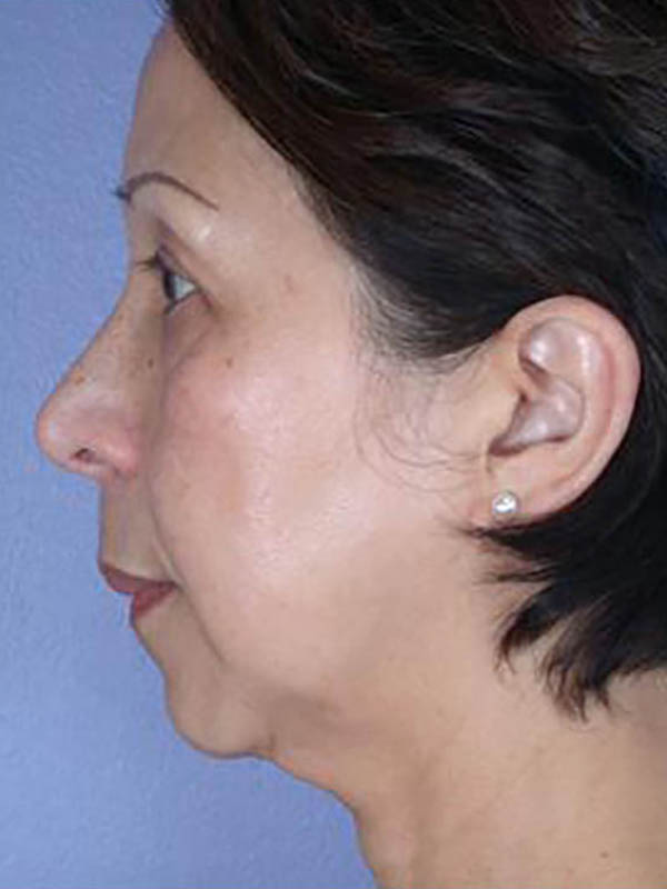 Facelift Before & After Image