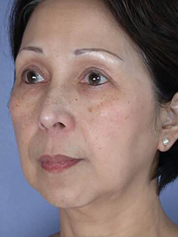 Facelift Before & After Image