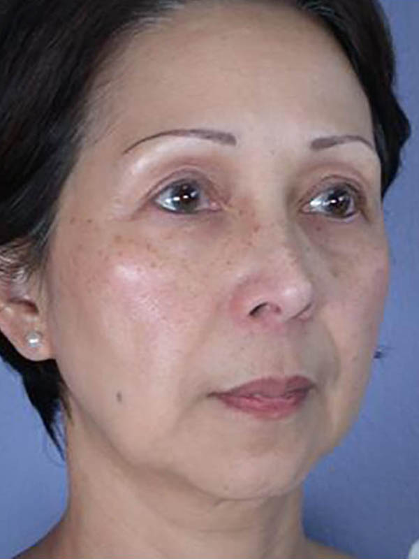 Facelift Before & After Image